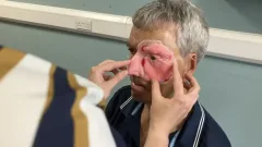 В Великобритании пострадавшему в аварии велосипедисту напечатали на 3D-принтере часть лица