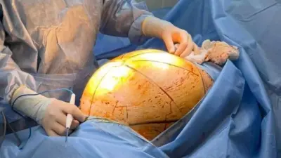 Алматинка с 25-килограммовой опухолью покупала в кредит БАДы для лечения, но не обращалась к врачам