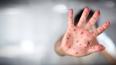 В Атырауской области более половины пациентов, заболевших корью, оказались не привиты