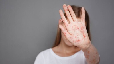 Корь – во всех регионах. Где больше всего заражённых
