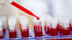 Жительница Аргентины избавилась от ВИЧ без лекарств. Это второй такой случай в истории