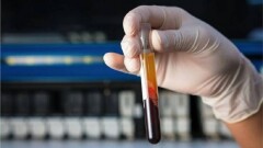 В Англии начались испытания революционного теста. Он должен определять рак до первых симптомов