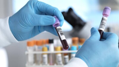 Учёные: новый метод выявления рака по анализу крови даёт хорошие результаты. 2 из 3 диагнозов верны