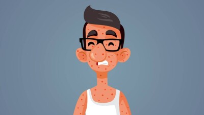 Как передаётся корь и есть ли лечение? Ответы на восемь важных вопросов