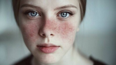 Болезнь Майкла Джексона и Селены Гомес. Чем опасна системная красная волчанка