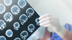 "Әрбір үшінші науқас көз жұмады". Дәрігер жастар арасында инсульт көбейгенін айтты