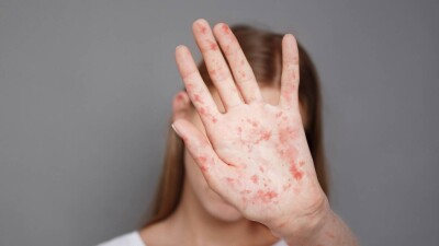 В Алматы с марта корью заболели не менее 1522 человек. В прошлом году случаев не фиксировали