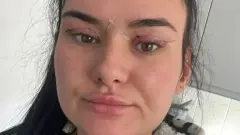 Открытые раны и глаза, которые не закрываются: женщины предупреждают об опасности дешевой блефаропластики