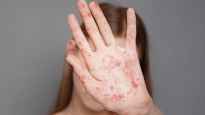 Ситуация с корью в Казахстане: с начала года в стране зарегистрировали 11 тысяч случаев заболевания