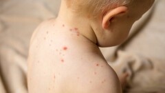Стационары Астаны работают в усиленном режиме из-за кори