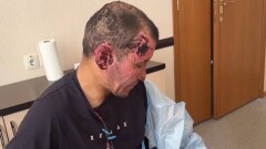 В Карагандинской области работник завода получил ожоги 35% тела при взрыве печи и требует компенсации от руководства