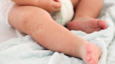 Отказ от вакцинации: в Астане продолжают регистрировать новые случаи кори среди детей