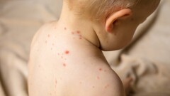 Двое детей умерли от кори в Казахстане