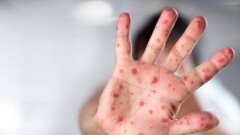 Жыл басынан бері қызылша жұқтырғандар саны 11 мыңнан асты