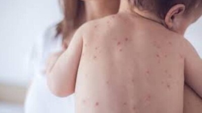 Қазақстанда қызылшадан екі сәби шетінеп кетті