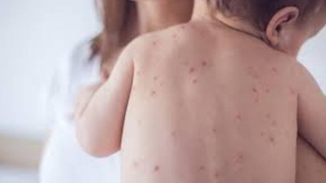 Қазақстанда қызылшадан екі сәби шетінеп кетті