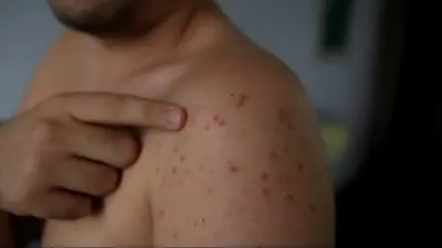 Карантин ввели в военном колледже в Щучинске: кадеты болеют корью