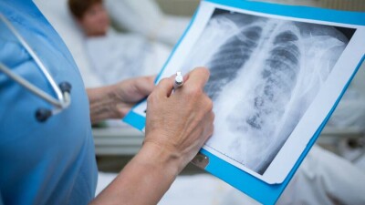 Пациенты с поражением лёгких до 50% относятся к больным средней степени тяжести. Их не госпитализируют в стационар