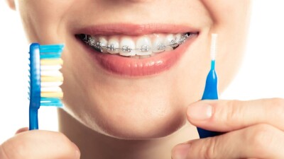 Брекет салдырмас бұрын не білу қажет? 12 сұраққа жауап