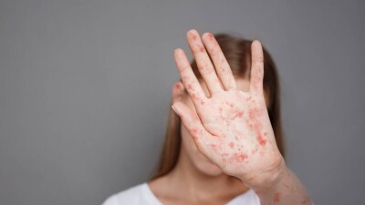 Қызылша қалай жұғады және оған қарсы екпе алу міндетті ме? Маңызды 8 сұраққа жауап