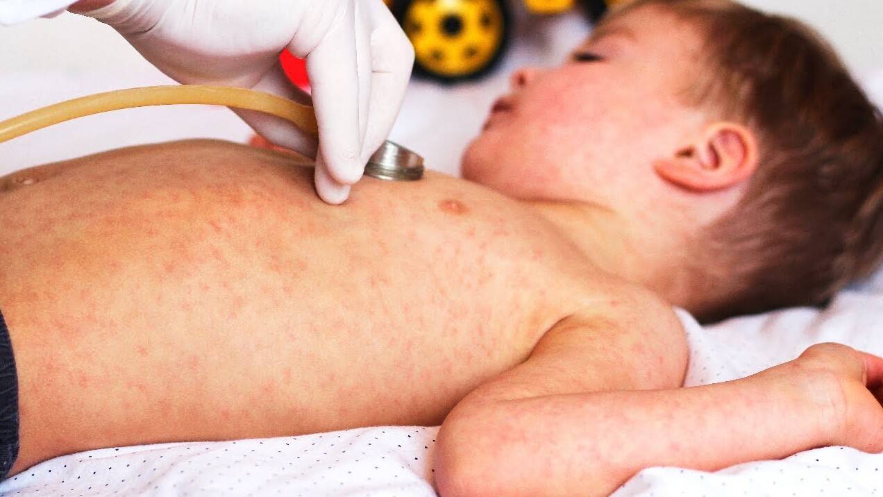 Қызылша барлық өңірде анықталды. Бұл дерт неге өршіп тұр?