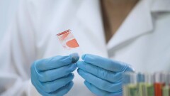 Қазақстанда сары ауруға шалдыққандар көбейді