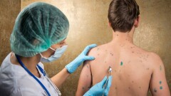 Желшешекке қарсы екпе алу дұрыс па? Дәрігер кеңесі