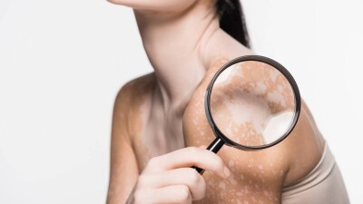 "Өзімді өзгеден кем сезінемін". Витилигоға шалдыққан қазақстандықтар қалай өмір сүреді?