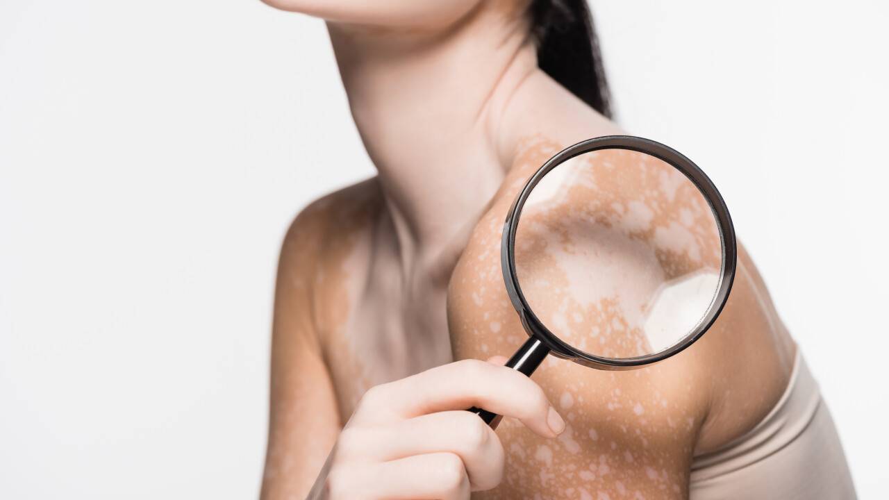 Витилигомен ауыратын порномодельдер