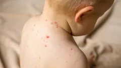 Вспышка кори в Кыргызстане: восемь детей умерли за два месяца