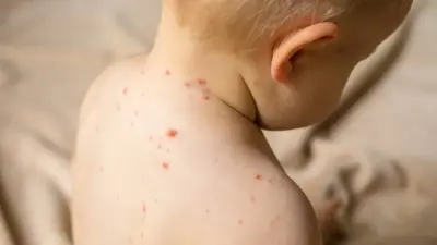 100 детей умерли от кори за месяц в Бангладеш, в стране начали экстренную вакцинацию 