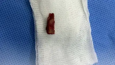 Кусочек ветки в голове ребёнка обнаружили врачи в Павлодаре спустя пять лет после травмы