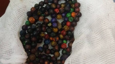 Хирурги Нур-Султана прооперировали семилетнюю девочку, проглотившую более 100 магнитов