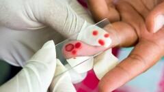 Лихорадку Денге подозревают у жительницы Алматы, вернувшейся из Таиланда