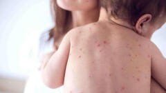 Қазақстанда қызылша ауруы өршіп тұр. Бұл ауру туралы не білу керек 