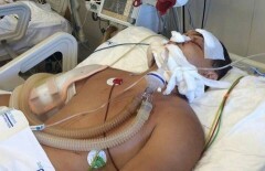 Пострадавшему в ДТП в Турции костанайцу через неделю сделают вторую операцию
