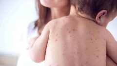 Корью с начала года в Казахстане заболели почти 600 человек