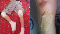 Пятилетний ребёнок получил серьёзные травмы обеих ног в аквапарке Алматы