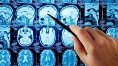 Актюбинку, перенёсшую инсульт, лечили от рака последней стадии
