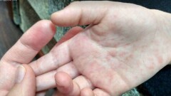 Четверо рабочих заболели корью на Тенгизском месторождении