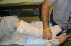 Ребёнок получил перелом бедра в детском саду в Алматинской области 