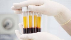 В Казахстане переливание больным с Covid-19 плазмы выздоровевшего человека оказалось неэффективным