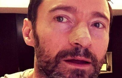 От рака кожи в пятый раз лечится голливудский актёр Хью Джекман