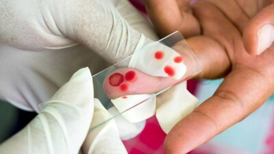 Лихорадку Денге подозревают у жительницы Алматы, вернувшейся из Таиланда