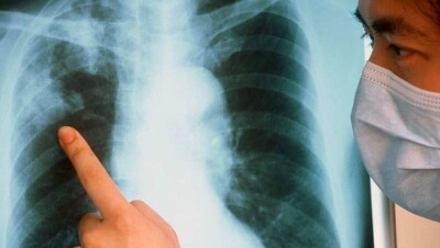 В детском саду Уральска медсестра заболела туберкулёзом