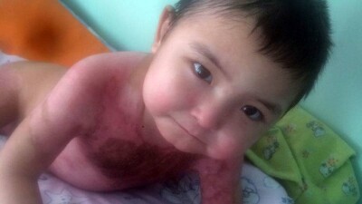 Опрокинувшего на себя кастрюлю с бульоном ребёнка выписывают из больницы Кокшетау