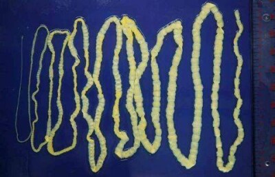 Шестиметрового червя достали из живота мужчины в Китае 