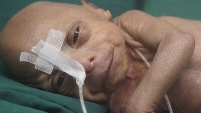 В Бангладеш родился младенец-старик