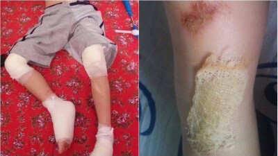 Пятилетний ребёнок получил серьёзные травмы обеих ног в аквапарке Алматы