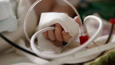 Опрокинувшему на себя кастрюлю с бульоном малышу из Кокшетау пересадили кожу